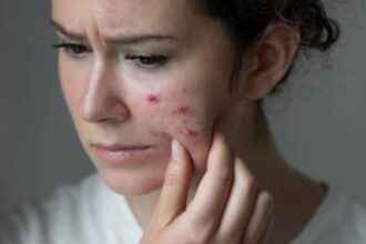 Kulit Berminyak dan Berjerawat