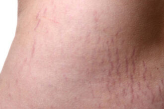 Stretch Mark