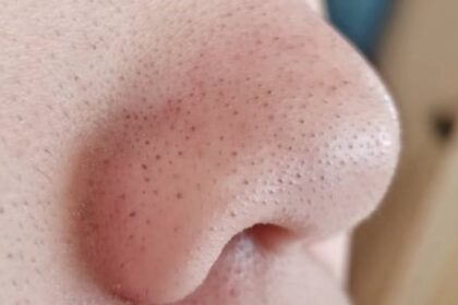 Cara Alami Hilangkan Komedo