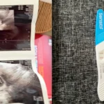 Langka Tapi Nyata, Wanita Ini Hamil Lagi Setelah Sterilisasi