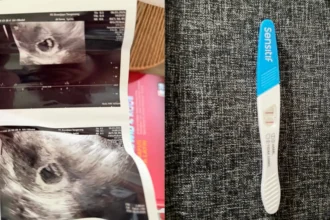 Langka Tapi Nyata, Wanita Ini Hamil Lagi Setelah Sterilisasi