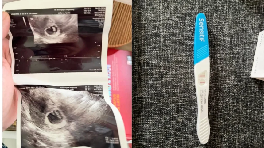 Langka Tapi Nyata, Wanita Ini Hamil Lagi Setelah Sterilisasi